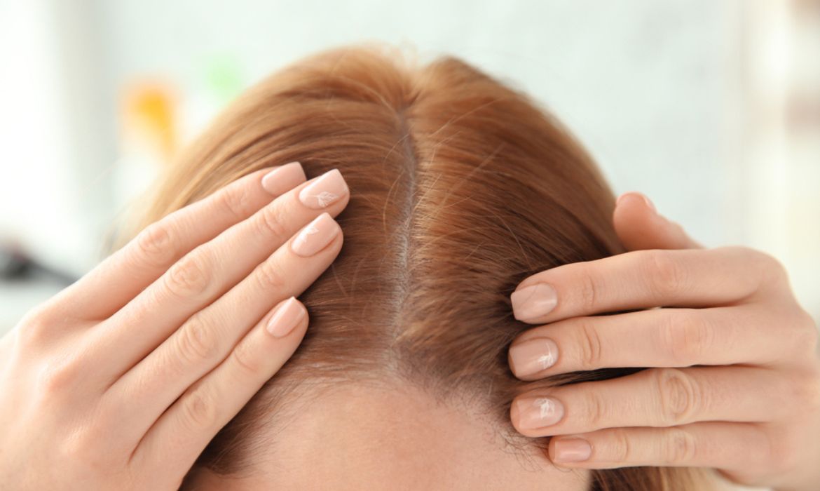 وصفات طبيعية للتخلص من الدهون الزائدة في فروة الرأس