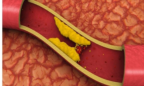 البروتين الدهني (أ) Lp(a)