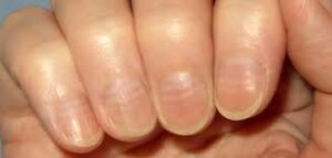 علامات نقص فيتامين د