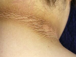 ظهور بقع داكنة على الرقبة