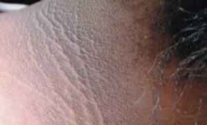 ظهور بقع داكنة على الرقبة