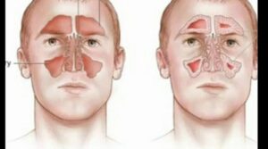 علاج الجيوب الأنفية